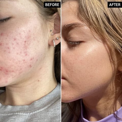 The Ordinary Niacinamide 10% + Zinc 1% Serum - Image 10